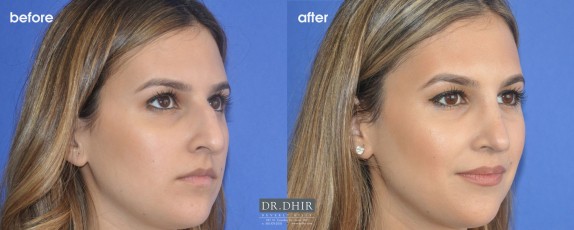 drdhir-rhinoplasty-nose-35-2