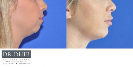 drdhir-facial-implant-5-3
