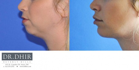 drdhir-facial-implant-5-5