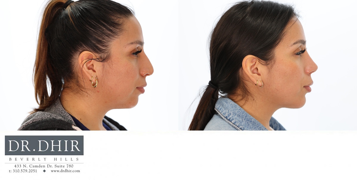 33 year old El Salvadorian Female with nasal hump, deviated nasal septum, wide nasal bones with an unrefined, bulbous and droopy tip worsened with smiling.  Nasal hump removed to provide a contoured bridge and the tip was refined and supported elegantly.  The nostrils were narrowed with alar wedge resection.