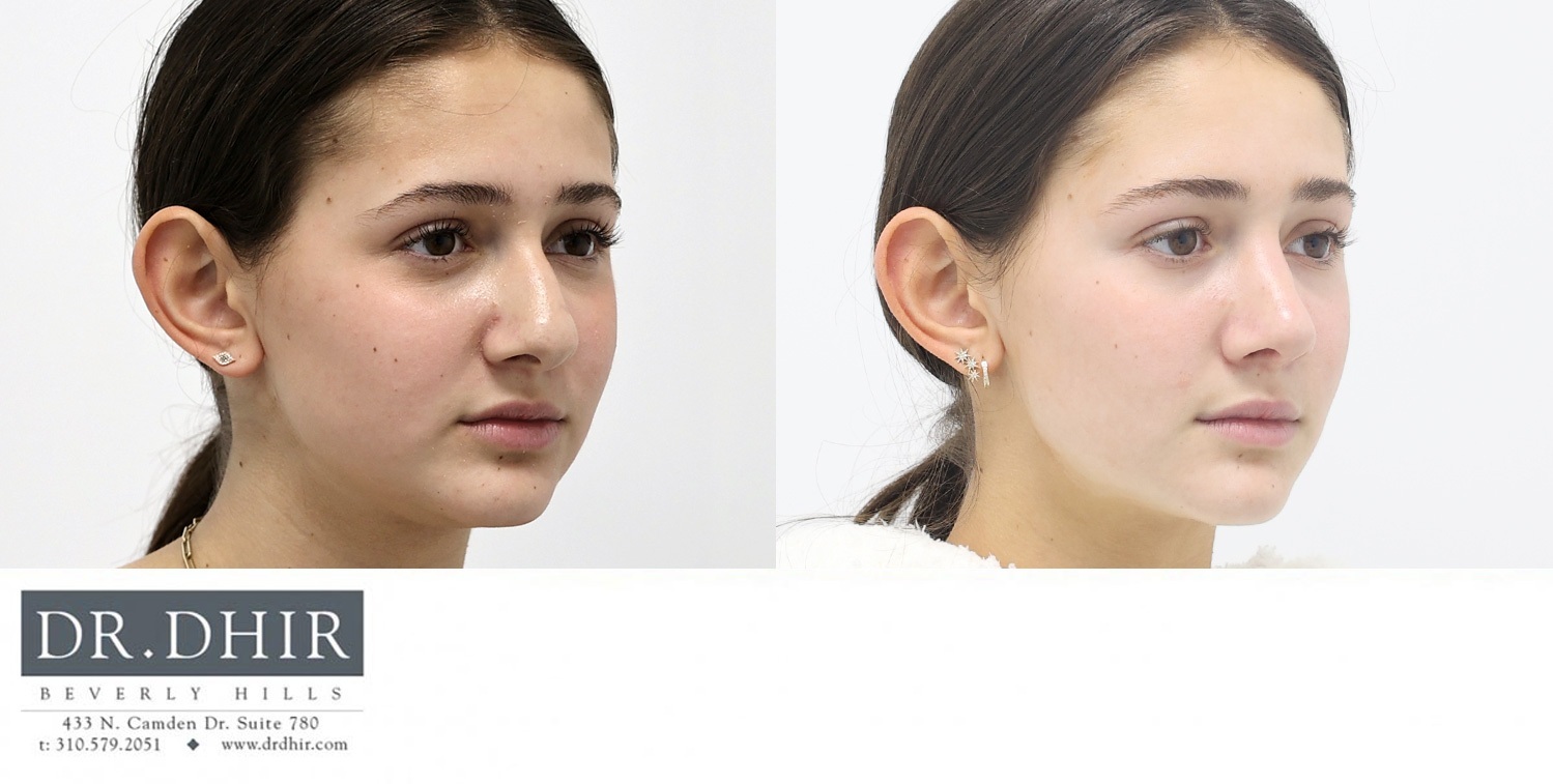 17 year old Female with nasal hump, crooked nasal septum, wide nasal bones with a bulbous, droopy and unsupported nasal tip with medium skin thickness.  The nasal hump was removed and the tip was refined and supported to maintain support with smiling.