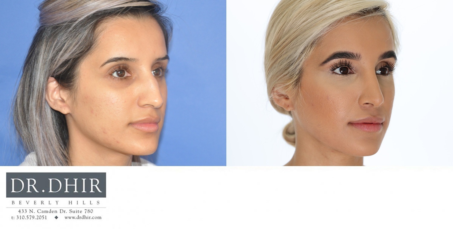 30 year old Middle Eastern Female with a nasal hump, wide nasal bones, deviated nasal septum and droopy, unsupported nasal tip.  The nasal hump was removed to provide a contoured bridge, septum was straightened, and the nasal tip was supported with cartilage grafting.
