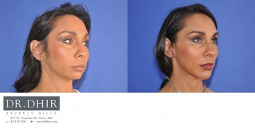 drdhir-facial-implant-6-2