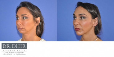 drdhir-facial-implant-6-4