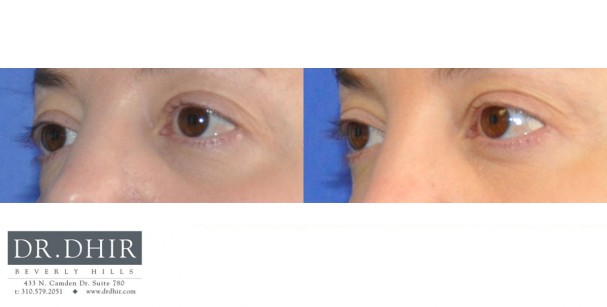 drdhir-eyes-8-1