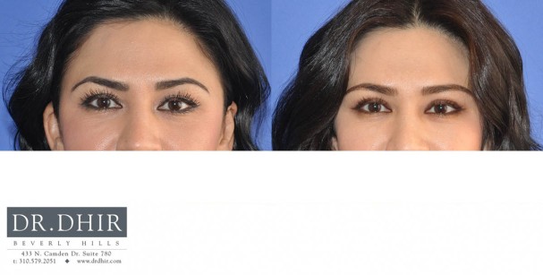 drdhir-eyes-9-1-web