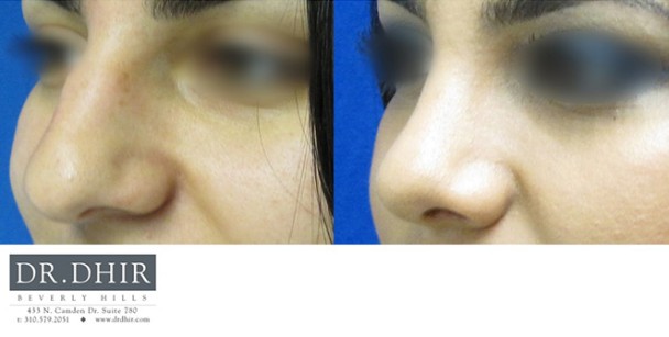 Nose-1