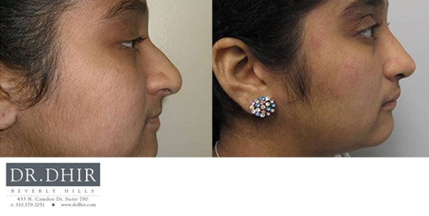 Nose-12