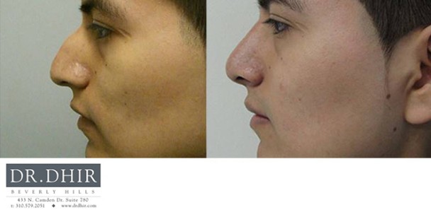 Nose-13