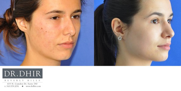 Nose-14-1
