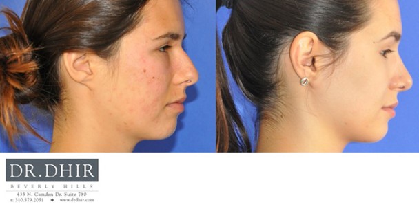 Nose-14-2