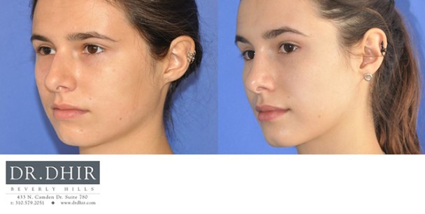 Nose-14-3