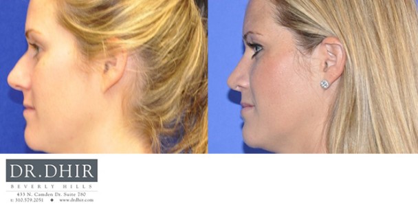 Nose-2-1