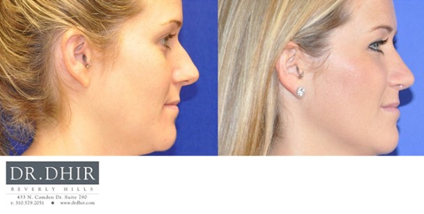 Nose-2-4