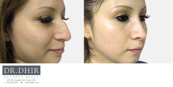 Nose-3-2