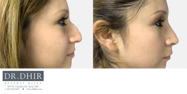 Nose-3-3