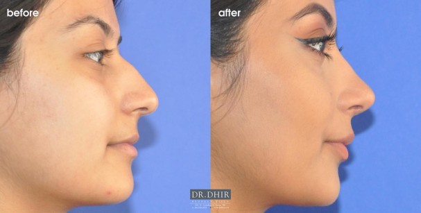 drdhir-nose-34-3-1