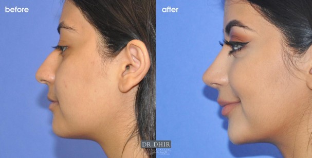 drdhir-nose-34-5-1