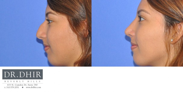 drdhir-nose-35-10