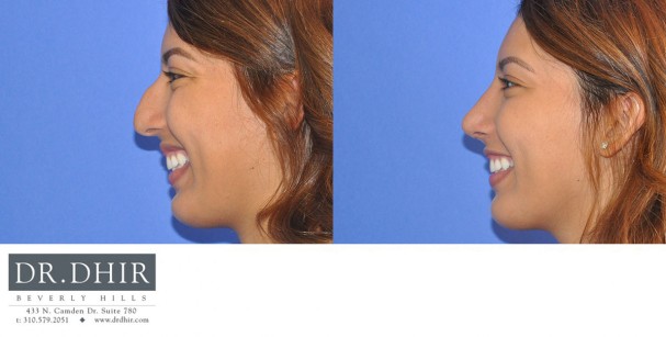 drdhir-nose-35-11