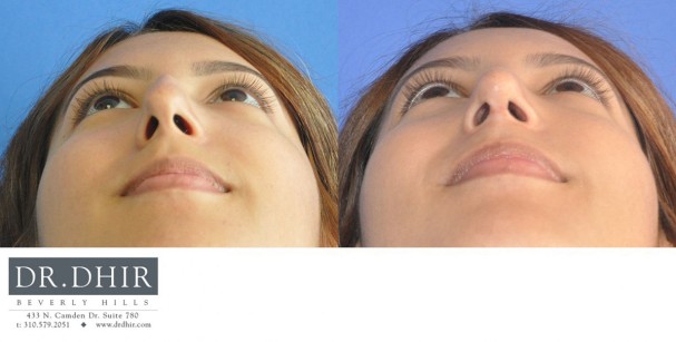 drdhir-nose-35-2