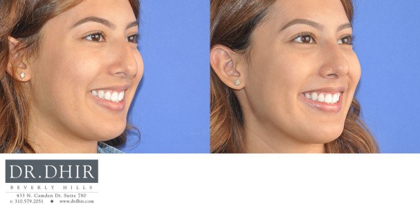 drdhir-nose-35-5
