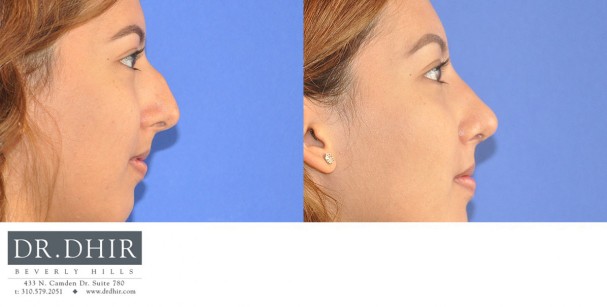 drdhir-nose-35-6