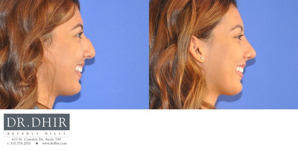 drdhir-nose-35-7