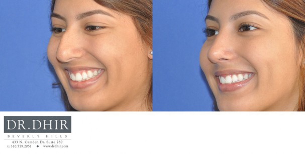 drdhir-nose-35-9