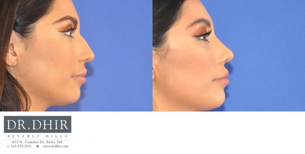drdhir-nose-37-3
