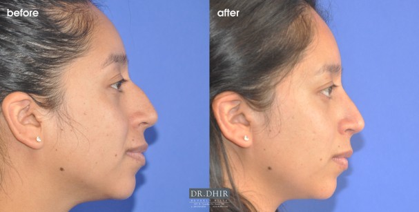 drdhir-nose-52-1