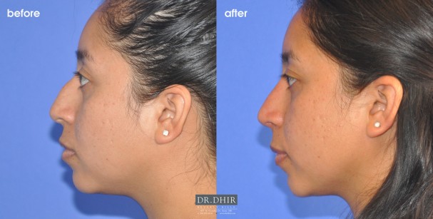 drdhir-nose-52-2
