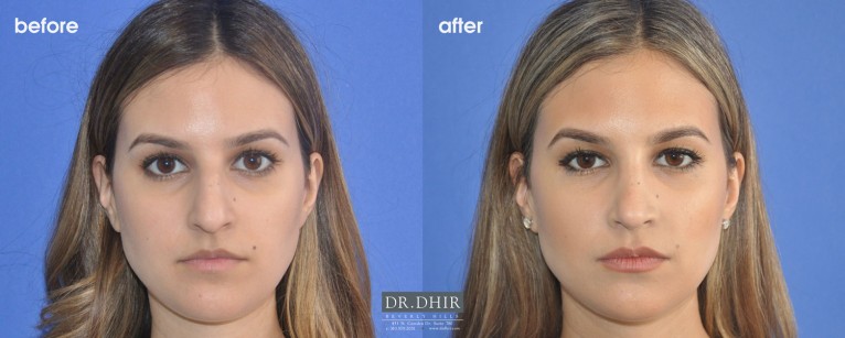 drdhir-rhinoplasty-nose-35-1