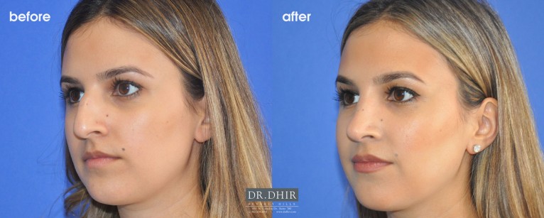 drdhir-rhinoplasty-nose-35-4
