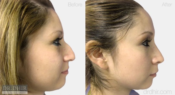 nose1
