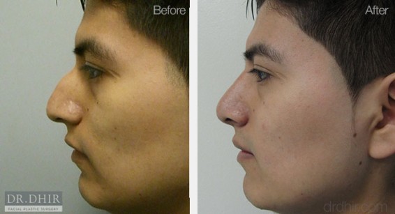 nose10