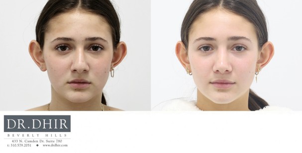 17 year old Female with nasal hump, crooked nasal septum, wide nasal bones with a bulbous, droopy and unsupported nasal tip with medium skin thickness.  The nasal hump was removed and the tip was refined and supported to maintain support with smiling.