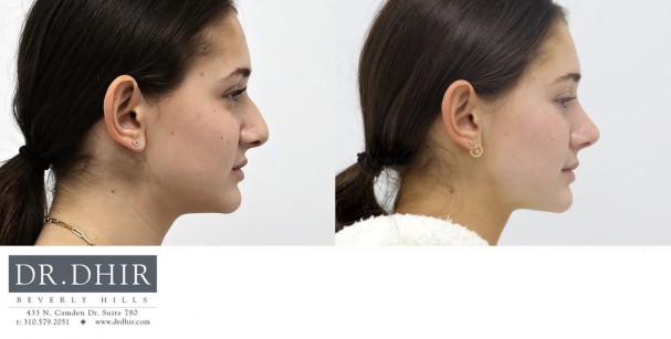 17 year old Female with nasal hump, crooked nasal septum, wide nasal bones with a bulbous, droopy and unsupported nasal tip with medium skin thickness.  The nasal hump was removed and the tip was refined and supported to maintain support with smiling.