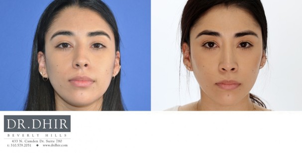 27 year old Hispanic Female with medium skin thickness presenting with nasal hump, crooked nasal septum and a bulbous, rotated tip.  The nasal hump was removed, the septum was straightened and the tip was slightly derotated and projected.