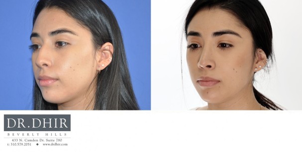 27 year old Hispanic Female with medium skin thickness presenting with nasal hump, crooked nasal septum and a bulbous, rotated tip.  The nasal hump was removed, the septum was straightened and the tip was slightly derotated and projected.
