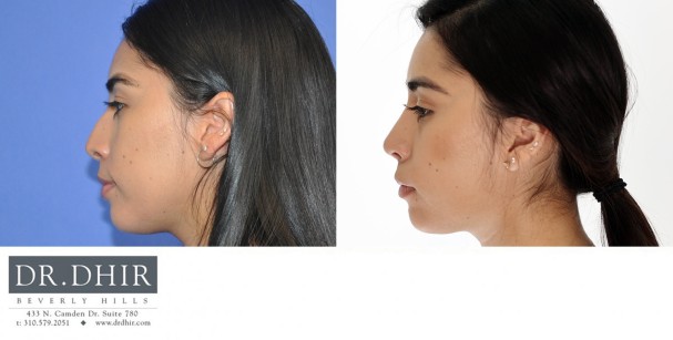 27 year old Hispanic Female with medium skin thickness presenting with nasal hump, crooked nasal septum and a bulbous, rotated tip.  The nasal hump was removed, the septum was straightened and the tip was slightly derotated and projected.