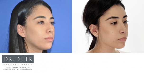27 year old Hispanic Female with medium skin thickness presenting with nasal hump, crooked nasal septum and a bulbous, rotated tip.  The nasal hump was removed, the septum was straightened and the tip was slightly derotated and projected.