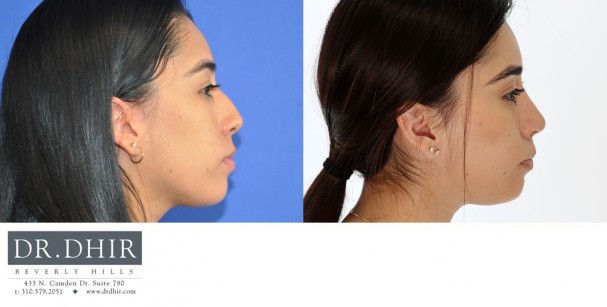 27 year old Hispanic Female with medium skin thickness presenting with nasal hump, crooked nasal septum and a bulbous, rotated tip.  The nasal hump was removed, the septum was straightened and the tip was slightly derotated and projected.