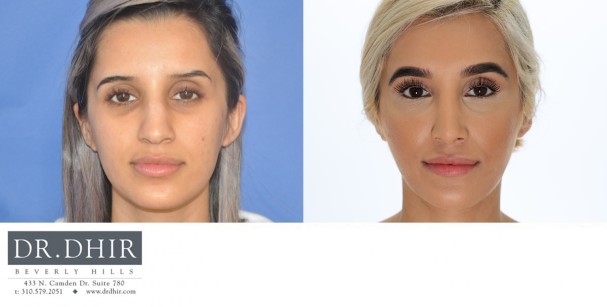 30 year old Middle Eastern Female with a nasal hump, wide nasal bones, deviated nasal septum and droopy, unsupported nasal tip.  The nasal hump was removed to provide a contoured bridge, septum was straightened, and the nasal tip was supported with cartilage grafting.