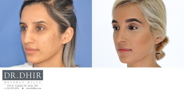 30 year old Middle Eastern Female with a nasal hump, wide nasal bones, deviated nasal septum and droopy, unsupported nasal tip.  The nasal hump was removed to provide a contoured bridge, septum was straightened, and the nasal tip was supported with cartilage grafting.