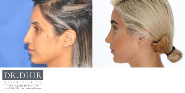 30 year old Middle Eastern Female with a nasal hump, wide nasal bones, deviated nasal septum and droopy, unsupported nasal tip.  The nasal hump was removed to provide a contoured bridge, septum was straightened, and the nasal tip was supported with cartilage grafting.