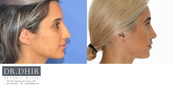 30 year old Middle Eastern Female with a nasal hump, wide nasal bones, deviated nasal septum and droopy, unsupported nasal tip.  The nasal hump was removed to provide a contoured bridge, septum was straightened, and the nasal tip was supported with cartilage grafting.