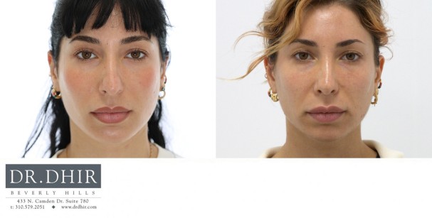 29 year old European female presents with nasal hump, over-projected, bulbous and droopy nasal tip.  An open rhinoplasty was performed with nasal hump removal, tip deprojection with rotation, nostril narrowing with alar wedge resection, and septal straightening.