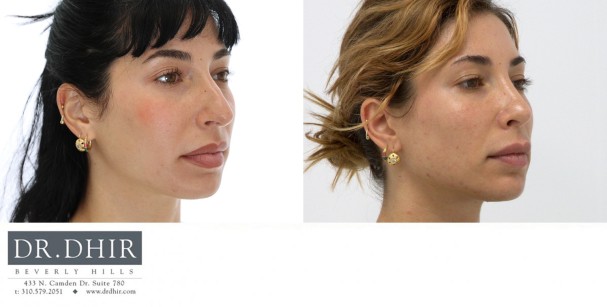 29 year old European female presents with nasal hump, over-projected, bulbous and droopy nasal tip.  An open rhinoplasty was performed with nasal hump removal, tip deprojection with rotation, nostril narrowing with alar wedge resection, and septal straightening.
