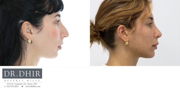 29 year old European female presents with nasal hump, over-projected, bulbous and droopy nasal tip.  An open rhinoplasty was performed with nasal hump removal, tip deprojection with rotation, nostril narrowing with alar wedge resection, and septal straightening.